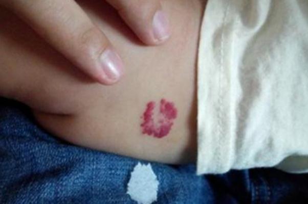 新生兒血管瘤能消退嗎 新生兒血管瘤治療費(fèi)用大概多少 新生兒血管瘤能消退嗎 新生兒血管瘤治療費(fèi)用大概多少