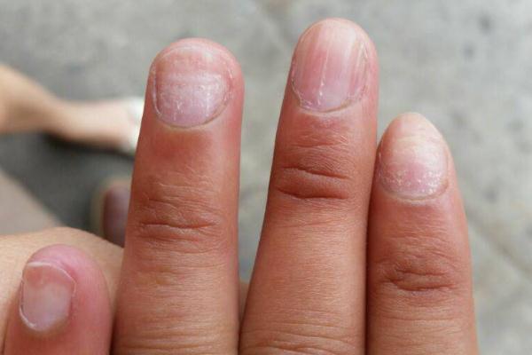 灰指甲有異味嗎 灰指甲有沒(méi)有傳染性