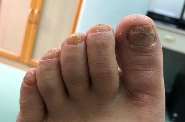 灰指甲的危害性有哪些 灰指甲是怎么引起的 灰指甲的危害性有哪些 灰指甲是怎么引起的