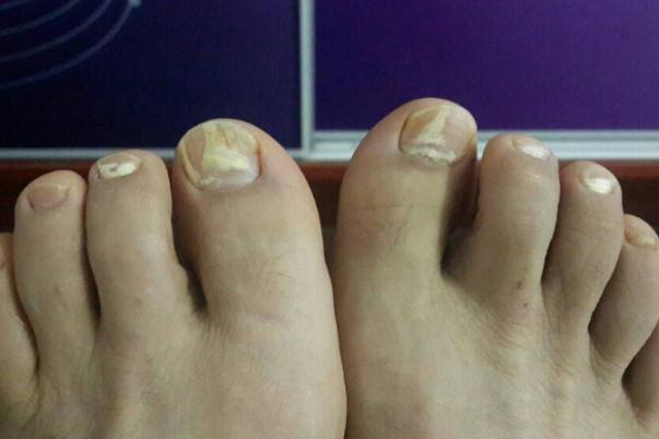 灰指甲有異味嗎 灰指甲有沒(méi)有傳染性