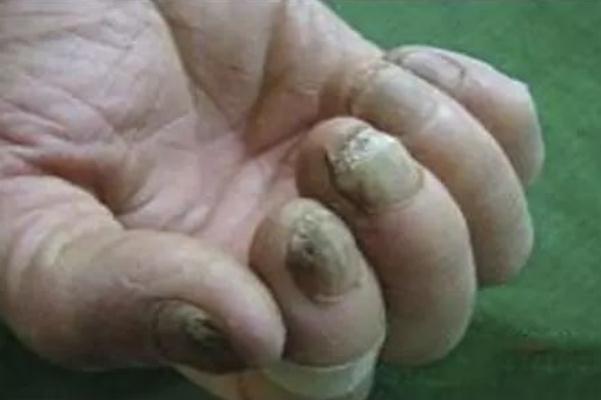 灰指甲有異味嗎 灰指甲有沒(méi)有傳染性