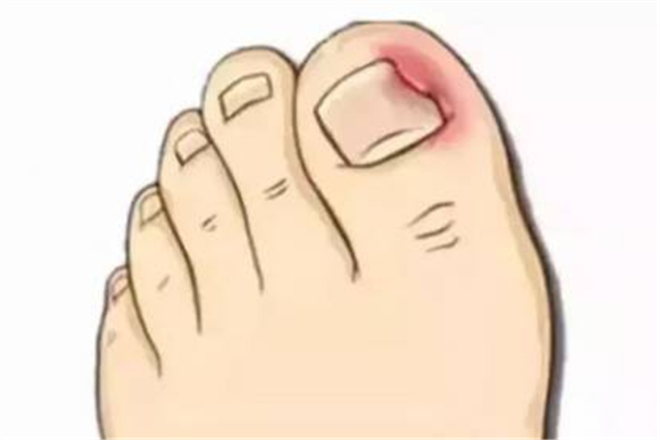 甲溝炎要拔掉整個(gè)指甲嗎 甲溝炎指甲拔了還能在長出來嗎