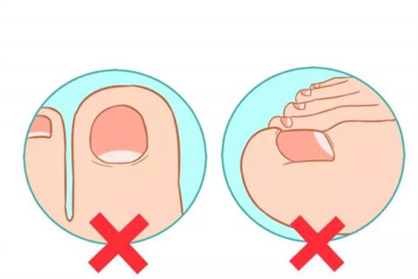 甲溝炎會復發(fā)嗎 甲溝炎為什么老是反反復復