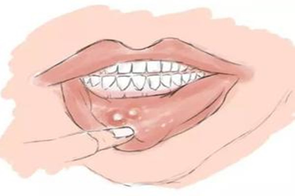 口腔潰瘍會導(dǎo)致臉腫嗎 口腔潰瘍會導(dǎo)致喉嚨痛嗎 口腔潰瘍會導(dǎo)致臉腫嗎 口腔潰瘍會導(dǎo)致喉嚨痛嗎