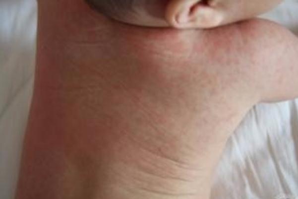 寶寶長(zhǎng)痱子有點(diǎn)化膿了怎么辦 寶寶長(zhǎng)痱子會(huì)癢嗎