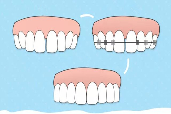 牙齒矯正會反彈嗎 牙齒矯正會改變嘴唇嗎 牙齒矯正會反彈嗎 牙齒矯正會改變嘴唇嗎