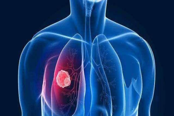 肺結核會導致不孕不育嗎 肺結核會導致輸卵管堵塞嗎