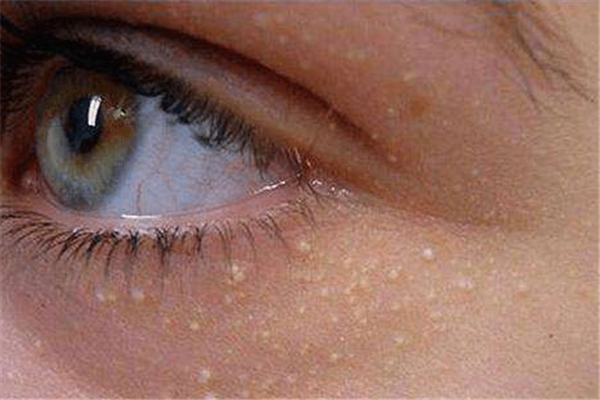 ?脂肪粒去除了還會長嗎 脂肪粒怎么預(yù)防 ?脂肪粒去除了還會長嗎 脂肪粒怎么預(yù)防