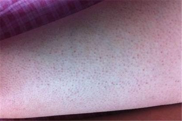 雞皮膚激光可以根治嗎 雞皮膚激光治療多少錢 雞皮膚激光可以根治嗎 雞皮膚激光治療多少錢