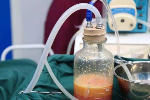 抽脂肪對身體有什么副作用 抽脂手術(shù)大概花多少錢 抽脂肪對身體有什么副作用 抽脂手術(shù)大概花多少錢