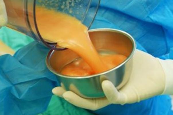 抽脂肪對身體有什么副作用 抽脂手術(shù)大概花多少錢 抽脂肪對身體有什么副作用 抽脂手術(shù)大概花多少錢