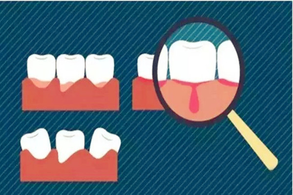 戴牙套能不能洗牙 戴牙套洗牙好嗎 戴牙套能不能洗牙 戴牙套洗牙好嗎