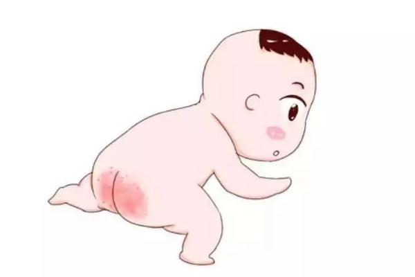 寶寶紅屁股怎么護(hù)理 寶寶紅屁股什么原因?qū)е?>
               <p class=
