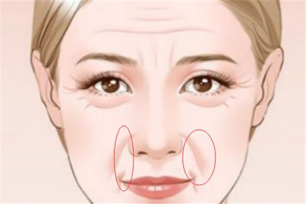 法令紋會(huì)徹底消除嗎 天生的法令紋能去掉嗎