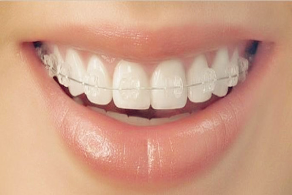 烤瓷牙的壽命是多久 烤瓷牙怎么護(hù)理 烤瓷牙的壽命是多久 烤瓷牙怎么護(hù)理