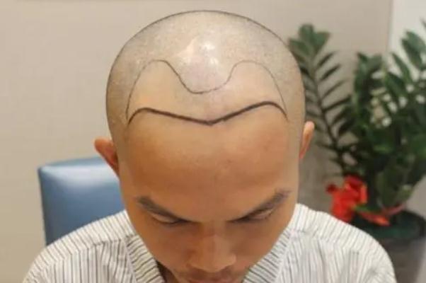 植發(fā)是用自己的頭發(fā)移植嗎 植發(fā)的危害和后遺癥 植發(fā)是用自己的頭發(fā)移植嗎 植發(fā)的危害和后遺癥