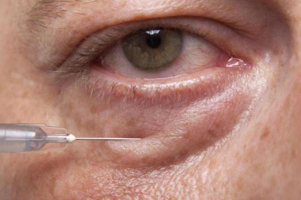 眼袋會(huì)不會(huì)遺傳 眼袋能自然消除嗎 眼袋會(huì)不會(huì)遺傳 眼袋能自然消除嗎