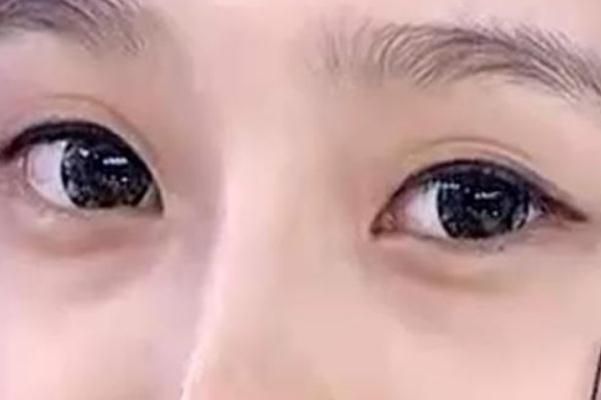 眼袋是脾虛引起的嗎 眼袋是哪個經絡堵塞