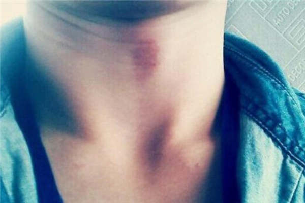 吻痕用雞蛋熱敷管用嗎 吻痕用雞蛋敷過后什么時(shí)候能消