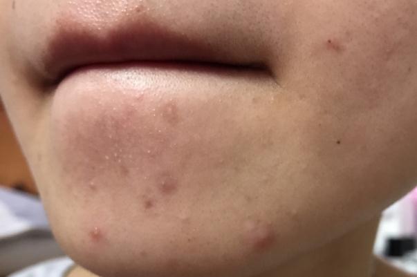 粉刺是痤瘡嗎 粉刺是螨蟲(chóng)造成的嗎 粉刺是痤瘡嗎 粉刺是螨蟲(chóng)造成的嗎