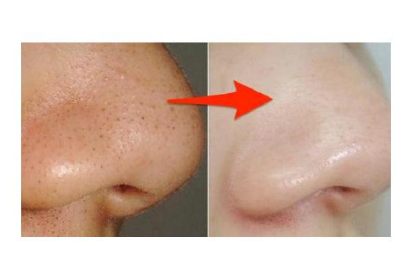 粉刺會疼嗎 粉刺會疼是為什么 粉刺會疼嗎 粉刺會疼是為什么