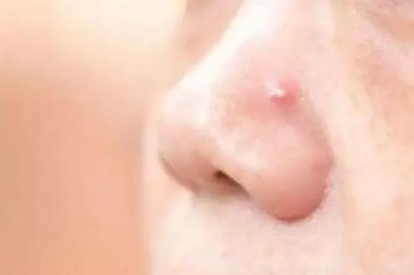 粉刺會(huì)留下痘印么 粉刺會(huì)長在哪些地方