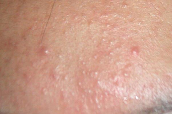 粉刺有硬塊但是擠不出來怎么辦 粉刺會(huì)傳染給別人嗎