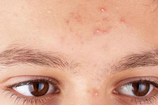 粉刺對(duì)身體有什么影響 擠黑頭粉刺會(huì)對(duì)皮膚有哪些影響