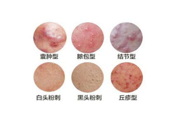 粉刺會疼嗎 粉刺會疼是為什么 粉刺會疼嗎 粉刺會疼是為什么