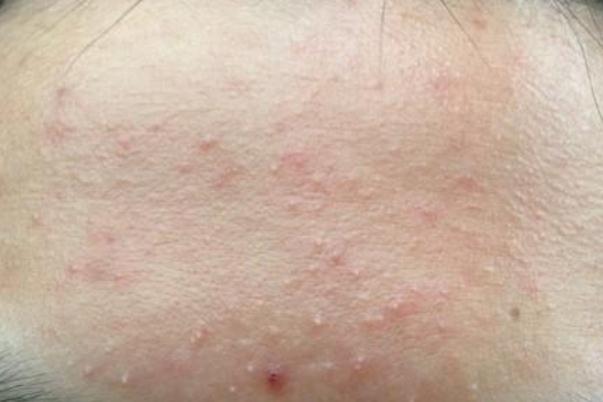 粉刺是痤瘡嗎 粉刺是螨蟲(chóng)造成的嗎 粉刺是痤瘡嗎 粉刺是螨蟲(chóng)造成的嗎