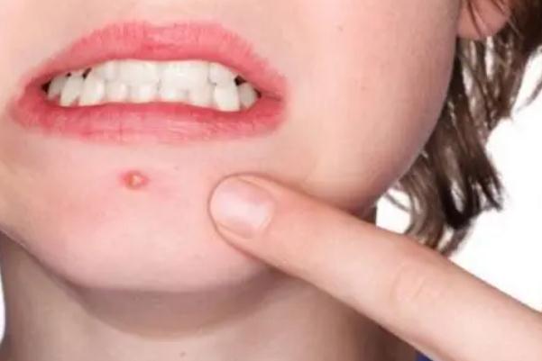 粉刺會(huì)留下痘印么 粉刺會(huì)長在哪些地方