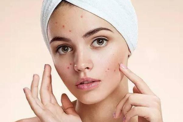 粉刺有硬塊但是擠不出來怎么辦 粉刺會(huì)傳染給別人嗎