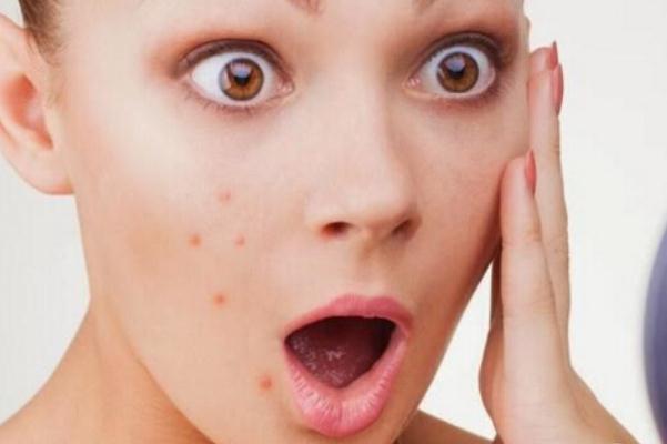 粉刺可以挑出來嗎 粉刺可以自己擠嗎 粉刺可以挑出來嗎 粉刺可以自己擠嗎