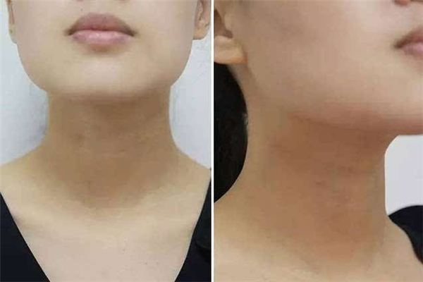 頸紋和胖瘦有關(guān)系嗎 頸紋是因?yàn)榕植庞械膯?>
               <p class=