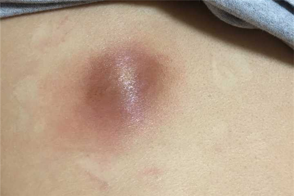 火癤子會(huì)復(fù)發(fā)嗎 火癤子為什么反復(fù)長