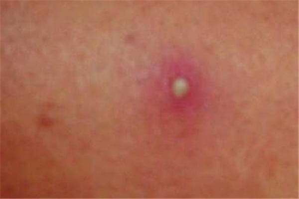 火癤子長(zhǎng)屁股上怎么辦 火癤子哪里都長(zhǎng)嗎