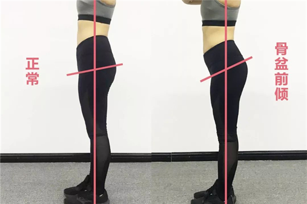 骨盆前傾有必要矯正嗎 骨盆前傾對身體的危害 骨盆前傾有必要矯正嗎 骨盆前傾對身體的危害