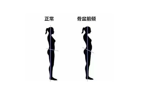 骨盆前傾的癥狀有哪些表現(xiàn) 骨盆前傾的原因 骨盆前傾的癥狀有哪些表現(xiàn) 骨盆前傾的原因