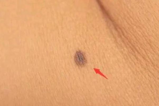 點痣要幾次才干凈 點痣要打麻藥嗎 點痣要幾次才干凈 點痣要打麻藥嗎