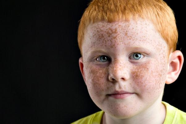 雀斑是遺傳的嗎 雀斑要怎么治療比較好 雀斑是遺傳的嗎 雀斑要怎么治療比較好