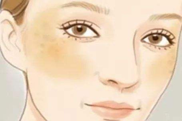 曬斑是什么樣子的 曬斑是因為防曬沒做好嗎 曬斑是什么樣子的 曬斑是因為防曬沒做好嗎