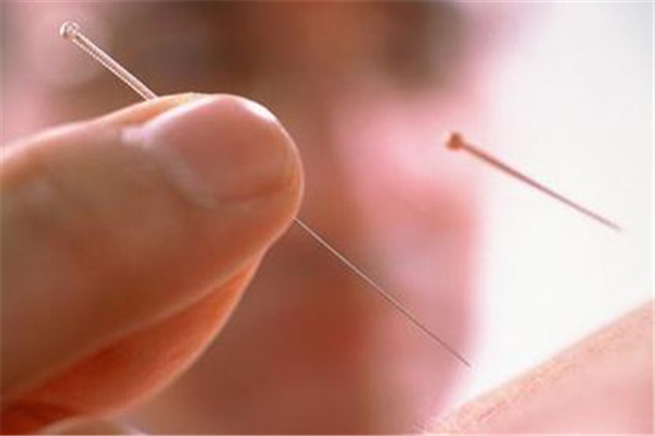 針灸會痛嗎 針灸有多疼