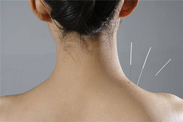 針灸后可以洗澡嗎 針灸后多久可以碰水 針灸后可以洗澡嗎 針灸后多久可以碰水