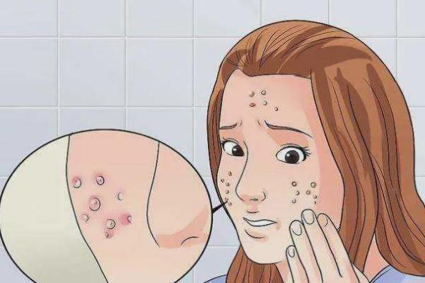 青春痘會長在哪些部位 青春痘會長在背上嗎 青春痘會長在哪些部位 青春痘會長在背上嗎