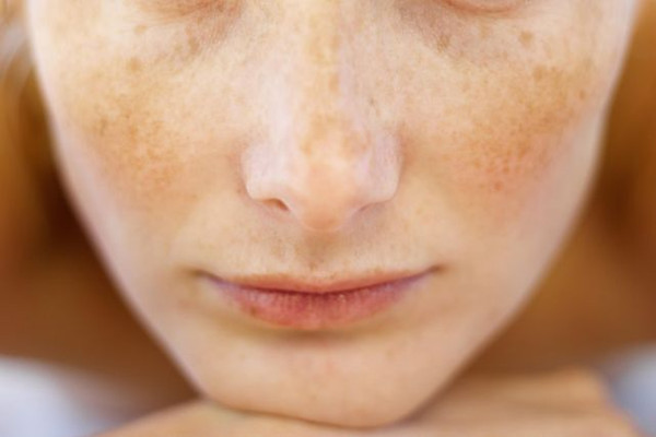 黃褐斑會不會遺傳 黃褐斑會不會越長越多 黃褐斑會不會遺傳 黃褐斑會不會越長越多