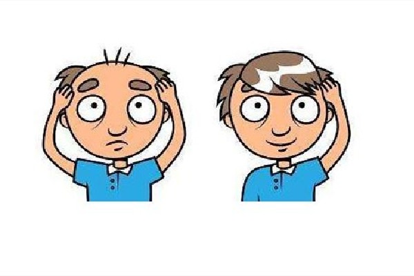 植發(fā)會(huì)不會(huì)再次脫落 植發(fā)用的是自己的頭發(fā)嗎