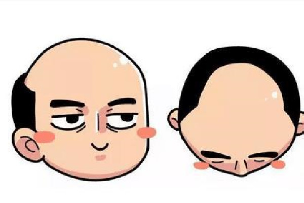 植發(fā)用的是哪里的毛囊 植發(fā)會不會有什么副作用