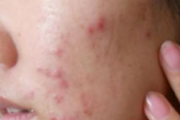 痘痘肌膚要涂防曬嗎 痘痘肌是先補(bǔ)水還是先祛痘 痘痘肌膚要涂防曬嗎 痘痘肌是先補(bǔ)水還是先祛痘