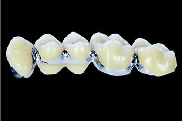 烤瓷牙要把牙齒都拔掉嗎 烤瓷牙有金屬嗎 烤瓷牙要把牙齒都拔掉嗎 烤瓷牙有金屬嗎