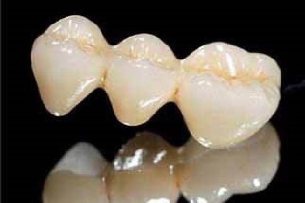 烤瓷牙會(huì)對(duì)原來(lái)的牙齒有影響嗎 烤瓷牙的利弊 烤瓷牙會(huì)對(duì)原來(lái)的牙齒有影響嗎 烤瓷牙的利弊